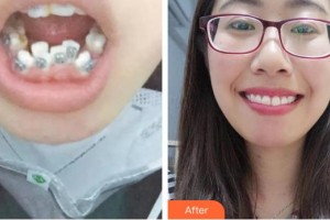 四平唯美醫(yī)療美容整形醫(yī)院王福星整形價格表附金屬托槽矯正案例展示