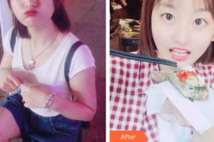 四平市燒傷整形醫(yī)院衛(wèi)長榮整形價格表附美白劑美白牙齒案例展示