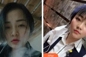 四平市燒傷整形醫(yī)院劉艷輝整形價格表附光子嫩膚案例展示