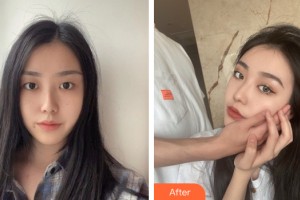 新疆千禧麗人整形美容醫(yī)院王海整形價格表附雙眼皮手術案例展示