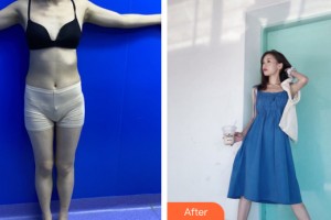 新疆華美整形美容醫(yī)院沈倩云整形價格表附吸脂減肥案例展示