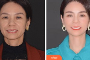 寧夏諾貝爾口腔醫(yī)院施麗娜整形價格表附牙齒矯正案例展示