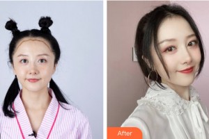 新疆威茲曼整形外科醫(yī)院董君整形價格表附植發(fā)案例展示