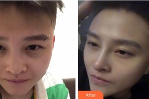 白山漢誠醫(yī)療美容門診部申文云住院醫(yī)師整形價格表附鼻部綜合案例展示