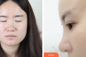 松原齊飛美容外科門診部杜彥超整形價格表附耳軟骨復合隆鼻案例展示