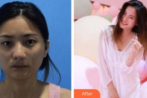 白城春俏美容整形醫(yī)院黃春整形價格表附埋線提升案例展示