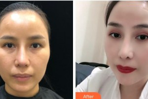 陜西省人民醫(yī)院燒傷整形醫(yī)學美容科鐘德才整形價格表附熱拉提案例展示