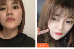 陜西華西醫(yī)院西美整形美容中心李明升整形價格表附埋線提升案例展示