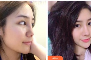 陜西省人民醫(yī)院燒傷整形醫(yī)學美容科孫要文整形價格表附鼻部綜合案例展示