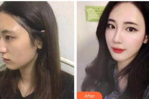 陜西華西醫(yī)院西美整形美容中心張菊芳整形價格表附假體隆鼻案例展示