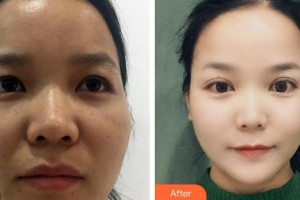 陜西省人民醫(yī)院燒傷整形醫(yī)學美容科張振信整形價格表附切開雙眼皮案例展示