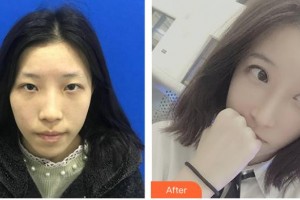 陜西省友誼醫(yī)院醫(yī)學整形科張永整形價格表附眼部綜合案例展示