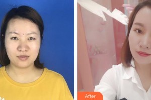 銅川礦務局中心醫(yī)院燒傷整形科諶煜整形價格表附切開雙眼皮案例展示