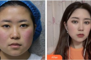 寶雞韓美醫(yī)療美容門診部李峰濤整形價格表附眼部綜合案例展示