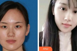 寶雞愛爾眼科醫(yī)院南銀娟整形價(jià)格表附眼部綜合案例展示