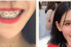 寶雞市口腔醫(yī)院趙春苗整形價(jià)格表附金屬托槽矯正案例展示