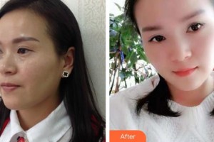 寶雞中心醫(yī)院燒傷整形科王云俠整形價(jià)格表附內(nèi)切祛眼袋案例展示