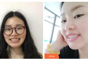 寶雞市口腔醫(yī)院高惠英整形價(jià)格表附金屬托槽矯正案例展示