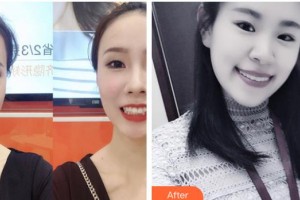 寶雞市口腔醫(yī)院張志成整形價格表附牙齒隱形矯正案例展示