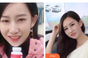 寶雞市口腔醫(yī)院賈懷斌整形價格表附牙齒隱形矯正案例展示