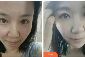 常熟市第一人民醫(yī)院燒傷整形科錢鐵石整形價格表附紅藍光祛痘案例展示