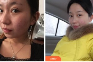 常熟瑞麗美貝爾美容醫(yī)院魯勝霞整形價格表附光子嫩膚案例展示