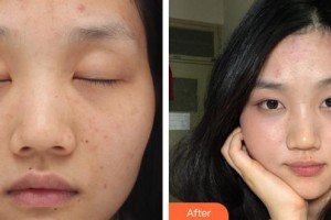 常熟時代醫(yī)療美容醫(yī)院周庭立整形價格表附激光祛斑案例展示