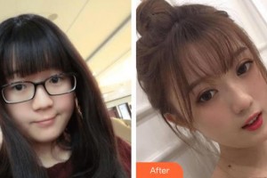 常熟市第一人民醫(yī)院燒傷整形科張琦整形價格表附切開雙眼皮案例展示