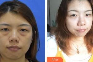 常熟市第五人民醫(yī)院皮膚醫(yī)學美容中心王雪松整形價格表附激光去眼袋案例展示