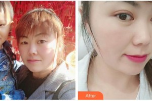 常熟市第二人民醫(yī)院眼科莊建青整形價格表附切開雙眼皮案例展示