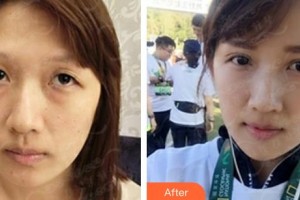 常熟市第二人民醫(yī)院眼科徐明整形價格表附埋線雙眼皮案例展示