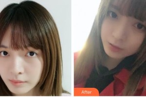 常熟市第二人民醫(yī)院眼科周衛(wèi)文整形價格表附切開雙眼皮案例展示