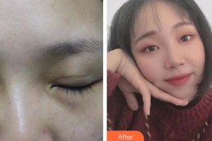 常熟市第二人民醫(yī)院眼科秦燕整形價格表附眼部修復案例展示