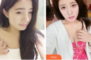 常熟市第二人民醫(yī)院眼科陳海英整形價格表附切開雙眼皮案例展示