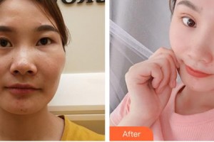 常熟市第二人民醫(yī)院眼科王瑾瑜整形價格表附切開雙眼皮案例展示