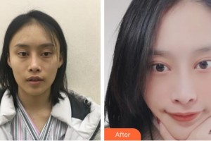 常熟市第二人民醫(yī)院眼科李函整形價格表附內切祛眼袋案例展示