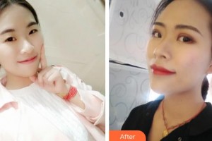 常熟廣仁醫(yī)院眼科薛振芳整形價格表附埋線雙眼皮案例展示