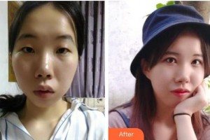 常熟廣仁醫(yī)院眼科盛敏杰整形價格表附眼部綜合案例展示