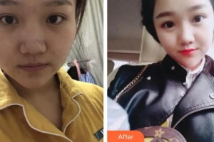 貴州省紅十字會婦女兒童醫(yī)院整形美容中心謝詩思整形價格表附紅藍(lán)光祛痘案例展示