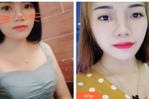 貴州省人民醫(yī)院整形美容燒傷顯微外科趙桂香整形價格表附激光祛斑案例展示