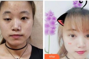 貴州醫(yī)科大學(xué)第二附屬醫(yī)院醫(yī)學(xué)美容整形外科彭洲整形價格表附彩光嫩膚案例展示