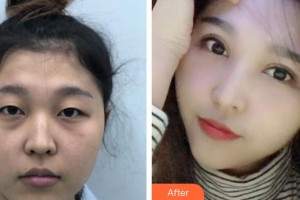 貴州醫(yī)科大學(xué)第二附屬醫(yī)院醫(yī)學(xué)美容整形外科楊光朝整形價格表附眼部綜合案例展示