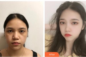 貴州歐貝頤醫(yī)療整形醫(yī)院孫超整形價格表附去痘印痘坑案例展示