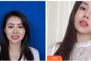 貴州整形美容外科醫(yī)院羅幼剛整形價格表附牙齒隱形矯正案例展示