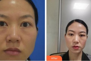 貴州晶朗眼科醫(yī)院董高亮整形價格表附激光去眼袋案例展示