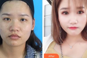 貴州整形美容外科醫(yī)院席小紅整形價(jià)格表附切開雙眼皮案例展示