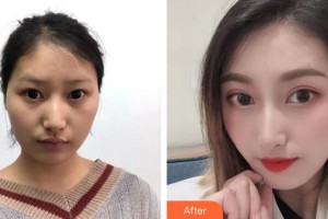 貴州普瑞眼科醫(yī)院張唯偉整形價(jià)格表附眼部綜合案例展示