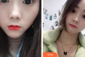 貴陽(yáng)愛爾眼科醫(yī)院陳曉鐘整形價(jià)格表附切開雙眼皮案例展示