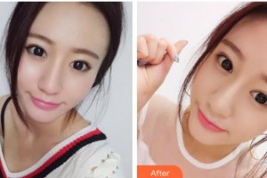 貴陽愛爾眼科醫(yī)院劉誠整形價格表附眼部修復(fù)案例展示