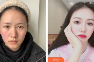 貴陽(yáng)愛爾眼科醫(yī)院孫儀亞整形價(jià)格表附眼部綜合案例展示